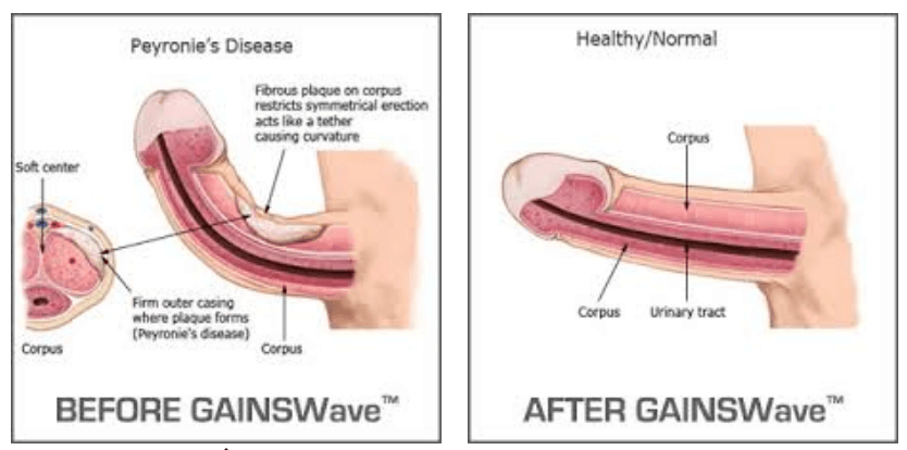 Peyronie s Disease Treatment in Cincinnati OH Non Invasive